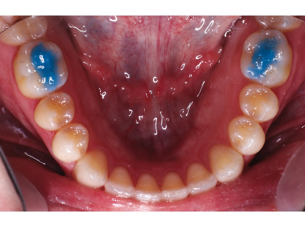 Ultra Band-Lok Blue Shade in Push Syringe - REF. NFUBLBPP, spuitje 5 g