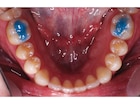 Ultra Band-Lok Blue Shade in Push Syringe - REF. NFUBLBPP, spuitje 5 g