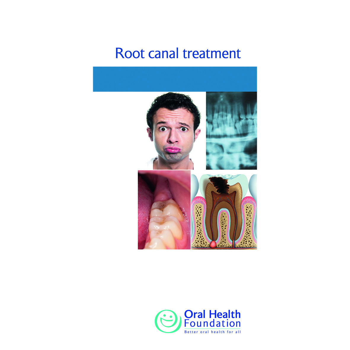 BDHF Leaflets Root Canal Treatment 100pk