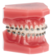 1165009_UK_Front_01_s_-TypodontCarriere-Distalizer-with-Clear-Aligners.png