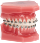 Carriere SLX Bracket Optimized Damon Standard Torque .022 U/L 5x5 Hooks on 3,4,5