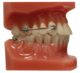 1183738_UK_Front_01_s_-Typodont-Carriere-Motion-Class-II-MtlClr-Aligner.png
