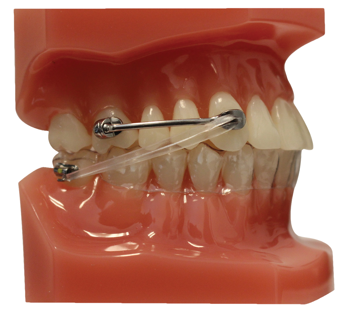 Typodont Carriere Motion Class II Mtl/Clr +Aligner