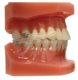 1183739_UK_Front_01_s_-Typodont-Carriere-Motion-Clear-With-Clear-Aligner.png