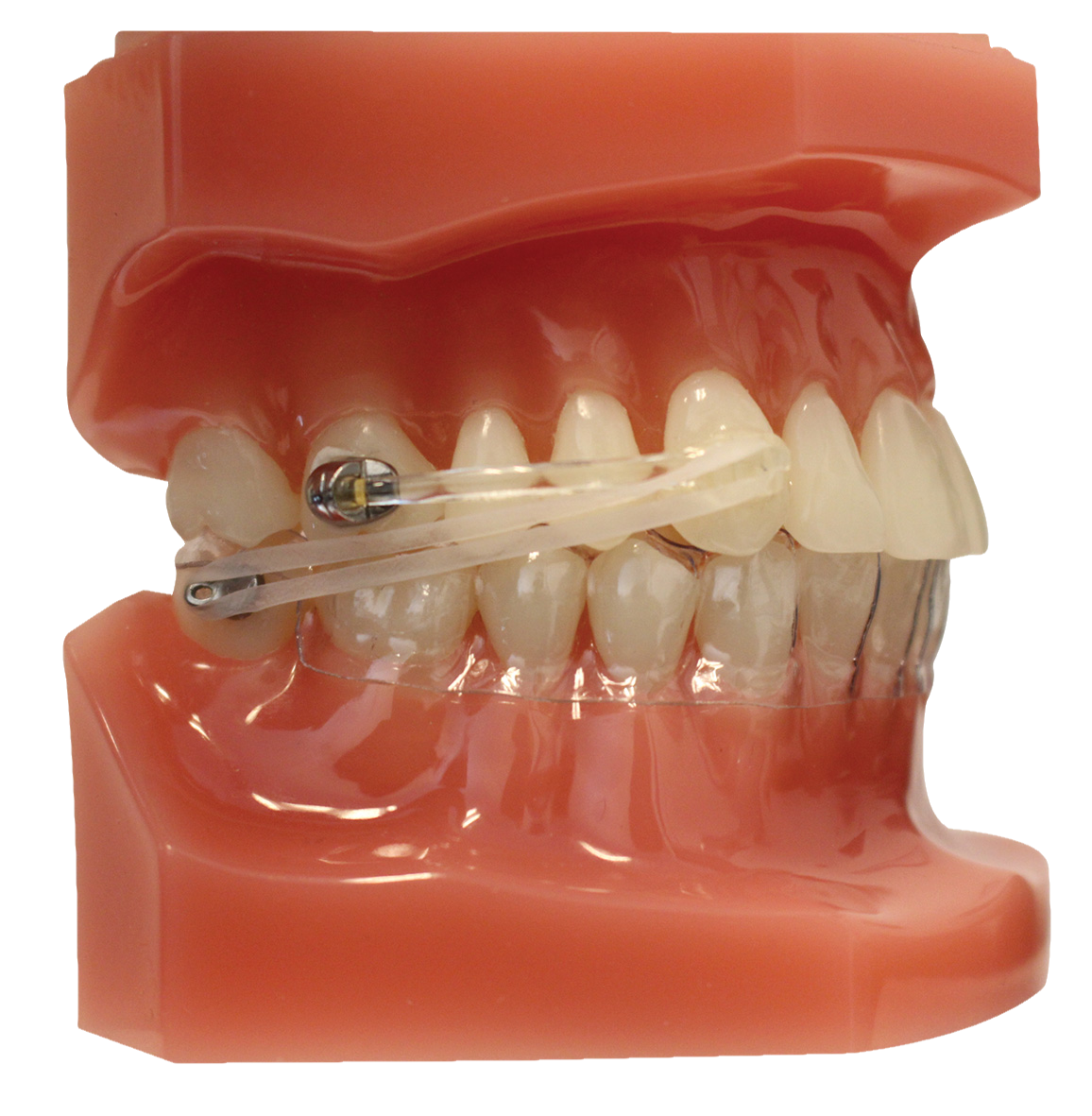 Typodont Carriere Motion Clear With Clear Aligner