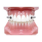 Carriere Motion 3D Class II Typodont Ea