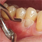LM-Cervical Matrixen - assortiment - LM 7600
