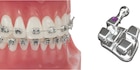 Votion MBT Prescription .022" Slot, navulling - 350-22-1100, centraal UR 11 - 10 stuks
