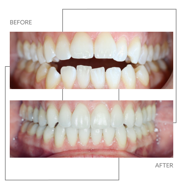 Smilers Clear Aligners