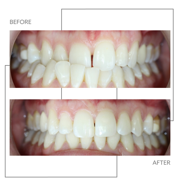 Smilers Clear Aligners