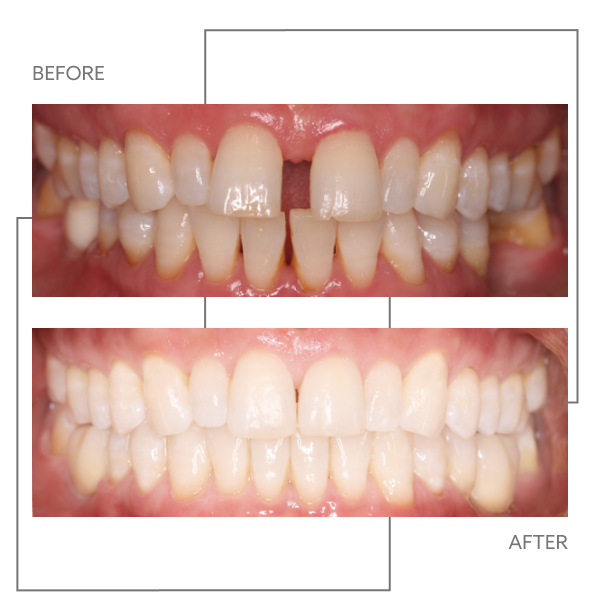 Smilers Clear Aligners