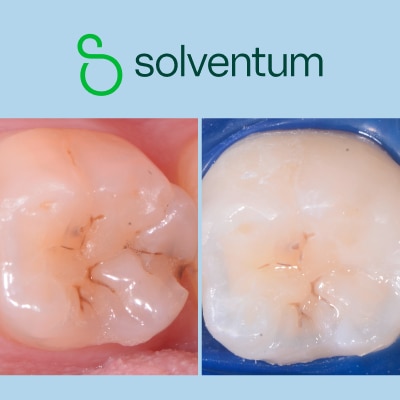 Solventum 3M Filtek One Bulk Restorative