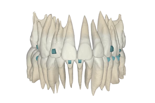 Smilers Clear Aligners for Modern Orthodontic Treatment