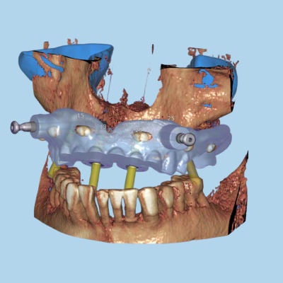 hyperDENT® CAM Software | Zahn Dental
